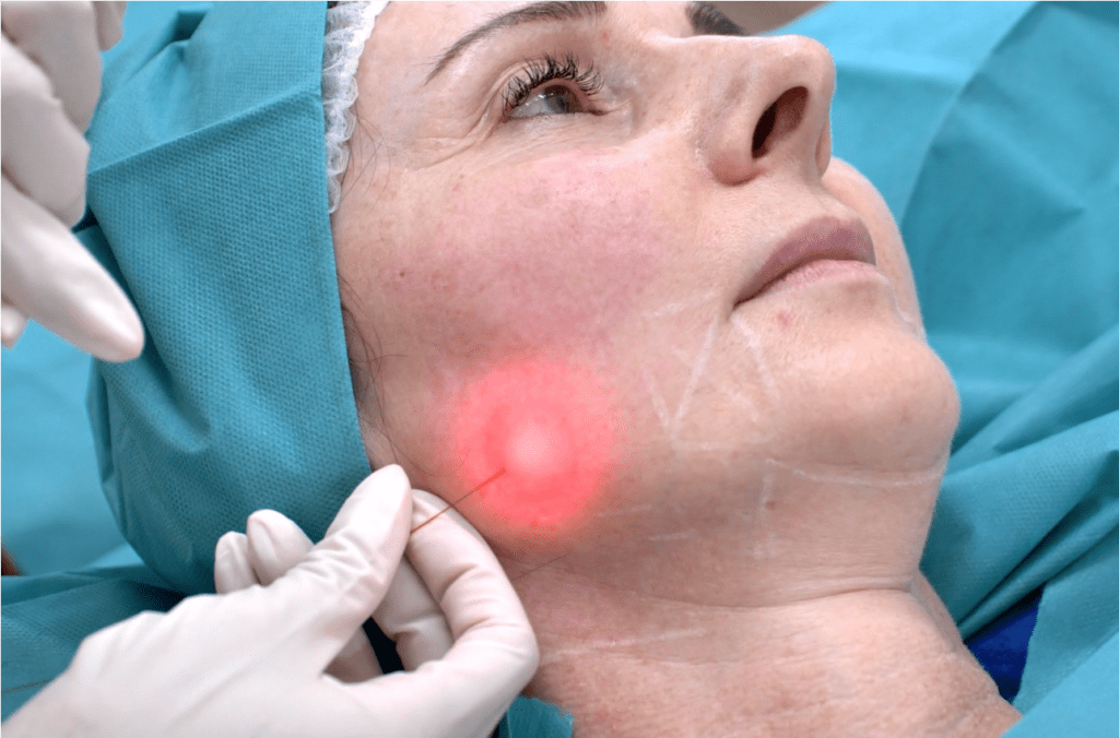 Endoface & Bodylift – ošetření dolní části obličeje