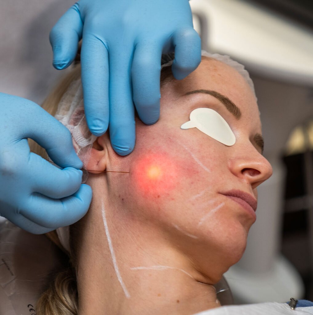 Endoface & Bodylift – laserové ošetření obličeje