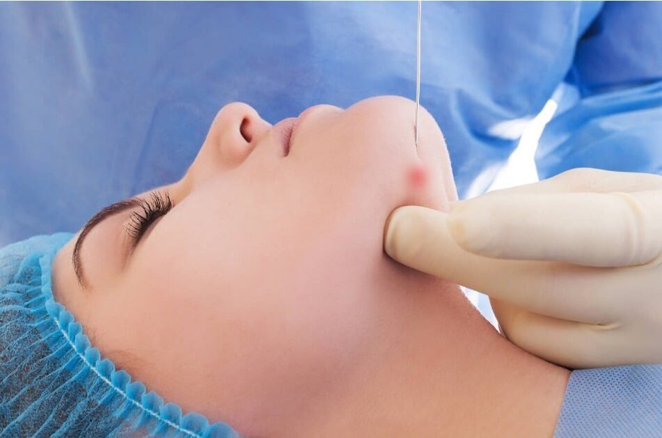Endoface & Bodylift – ošetření linie čelisti