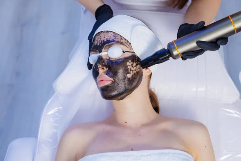 Karbonový peeling – laserové ošetření pleti s uhlíkovou maskou